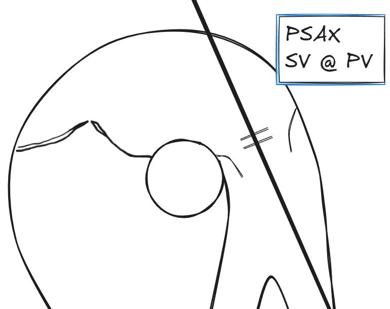 Parasternal short axis view showing sample volume placement