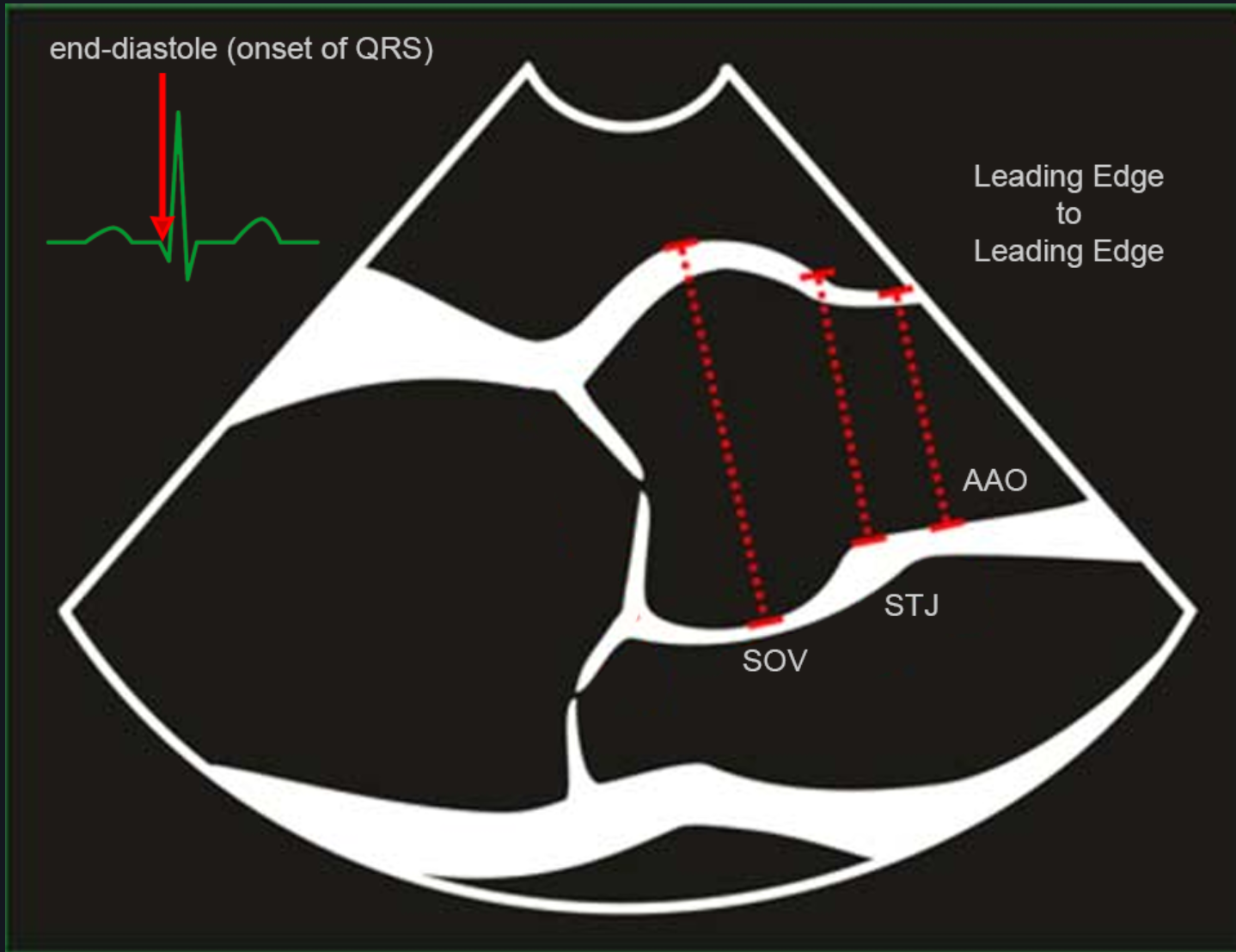 Dilated Aorta Finder (Dilated AF) screenshot
